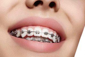 Harga Kawat Gigi dengan Manfaat yang Optimal